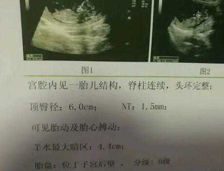 南京代生是怎么一个流程 南京鼓楼医院三代试管婴儿成功率： ‘四个月b超单子
